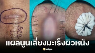 แผลตุ่มนูนสัญญาณเตือนมะเร็งผิวหนัง