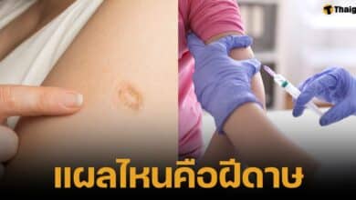 บอกวิธีสังเกตรอยแผลเป็นจากวัคซีนฝีดาษ ช่วยกันเอ็กพ็อกซ์ ต่างจากแผลวัคซีนวัณโรค