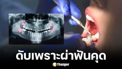 เด็ก 17 เสียชีวิตหลังไปถอนฟันคุด