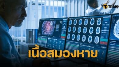 เนื้อสมองหาย 90%