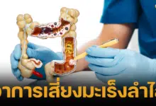 6 สัญญาณเตือน อาการสุ่มเสี่ยงของมะเร็งลำไส้ใหญ่ที่แพทย์แนะนำ มักพบในกลุ่มคนวัยหนุ่มสาวส่วนมากมักไม่รู้ตัวจนโรคลุกลามไปไกล