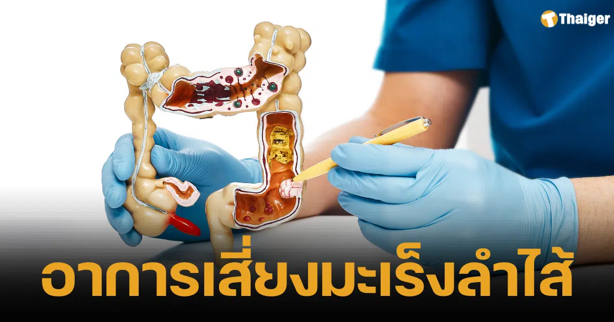 6 สัญญาณเตือน อาการสุ่มเสี่ยงของมะเร็งลำไส้ใหญ่ที่แพทย์แนะนำ มักพบในกลุ่มคนวัยหนุ่มสาวส่วนมากมักไม่รู้ตัวจนโรคลุกลามไปไกล