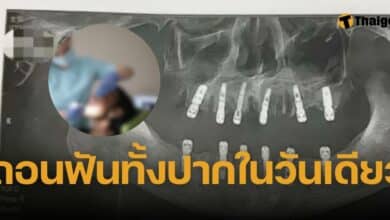 หมอจีน ถอนฟันคนไข้ 23 ซี่