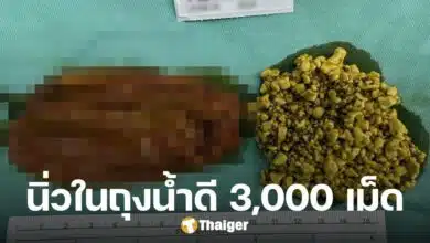 สุดช็อก สาววัย 45 ปีผ่าตัดถุงน้ำดี พบนิ่ว 3,000 เม็ด หมอผงะ สาเหตุเกิดจากอะไร?