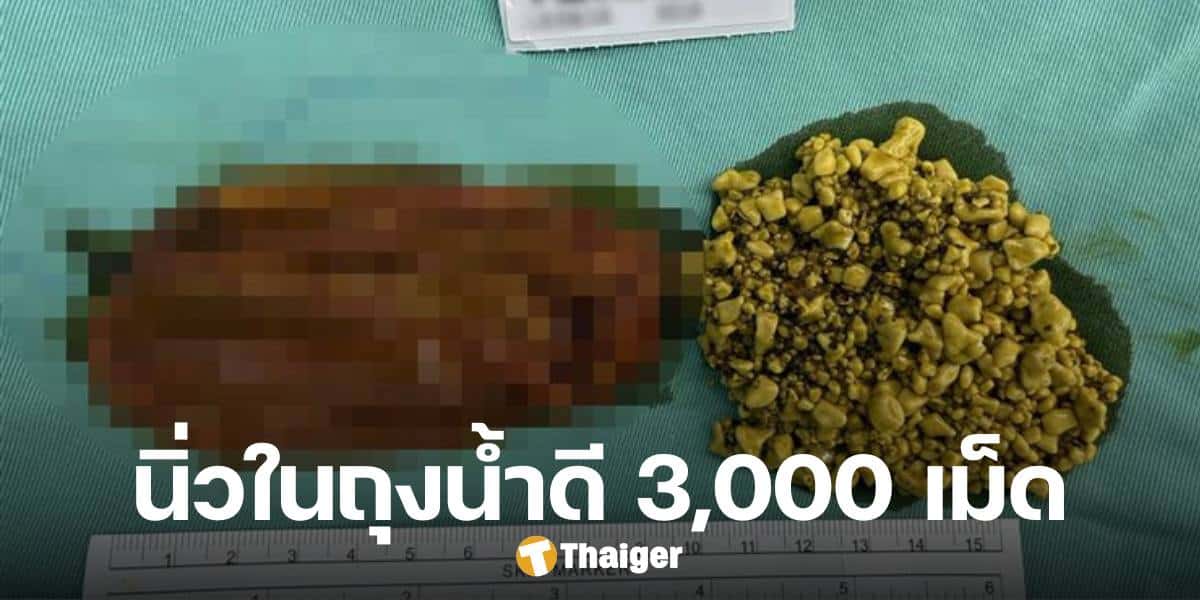 สุดช็อก สาววัย 45 ปีผ่าตัดถุงน้ำดี พบนิ่ว 3,000 เม็ด หมอผงะ สาเหตุเกิดจากอะไร?