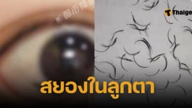 ขนตา 74 เส้นในลูกตา