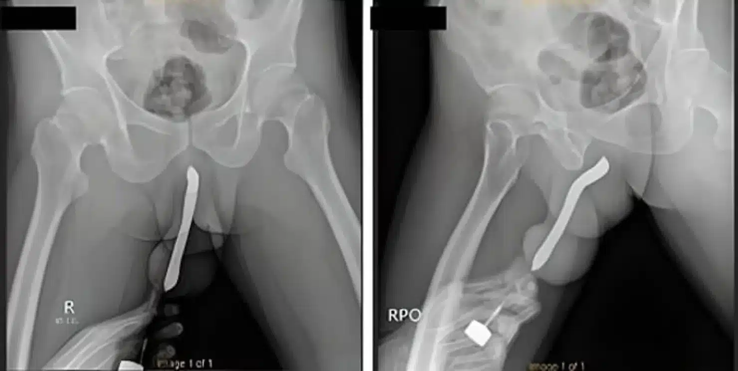 ใช้แปรงสีฟันเสียบเข้าไปในอวัยวะเพศ