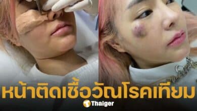 กัสจัง ทุกข์ใจหนัก หน้าติดเชื้อวัณโรคเทียม ทำจิตตก และสูญเสียรายได้เป็นล้าน