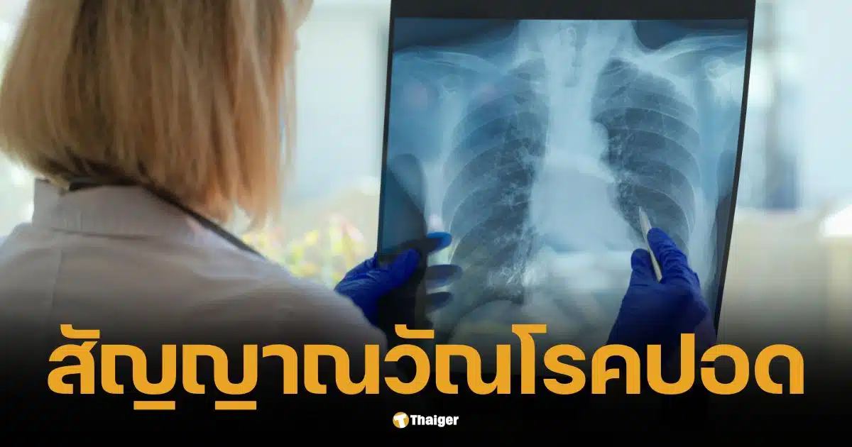 หญิงวัย 34 ไอเป็นเลือดวันเดียว แพทย์ตรวจพบวัณโรค เคราะห์ดีรักษาทัน