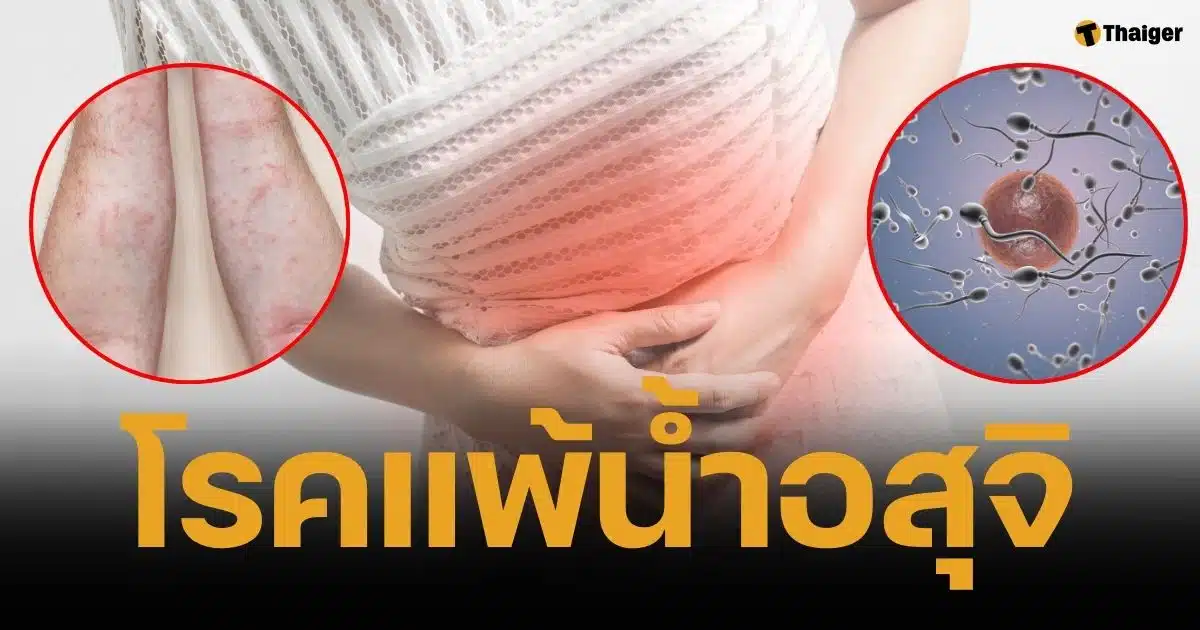 คู่รักไต้หวัน สุดซวย เมียแพ้น้ำอสุจิ แพทย์ชี้อยากมีลูกต้องผสมเทียม