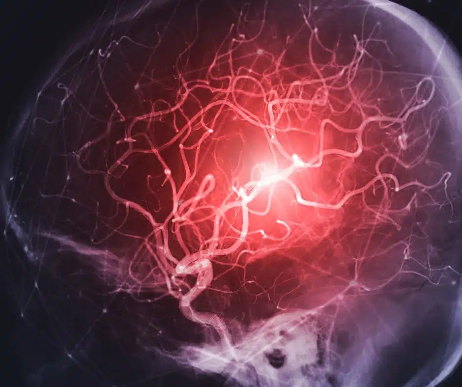 ภาวะเส้นเลือดในสมองตีบ