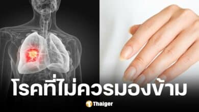 วิธีตรวจโรคมะเร็งปอดเบื้องต้นด้วยการดูลักษณะนิ้วมือ
