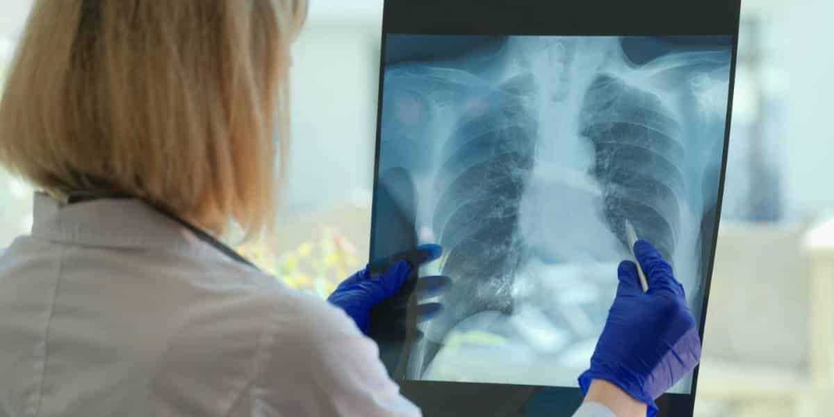 สถาบันสุขภาพแห่งชาติอังกฤษพบผู้ป่วยมะเร็งปอดรายใหม่ปีละ 43,000 ราย