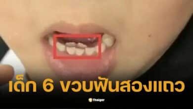 Stunned: 6-year-old child has two rows of teeth because parents raise the child too much