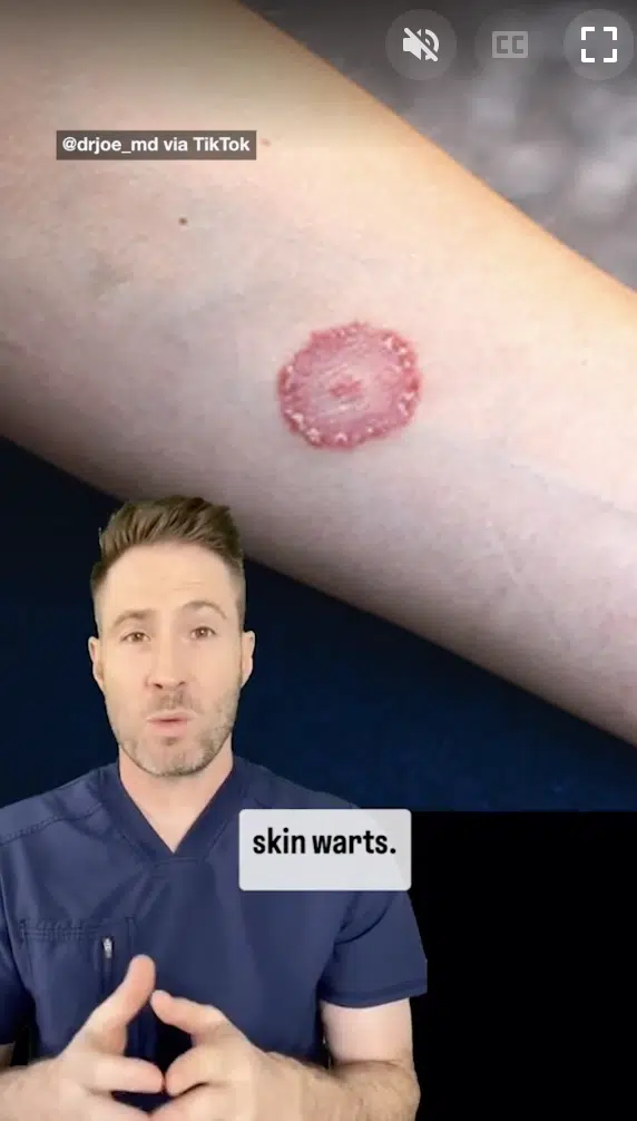 หมอชี้แจง โอกาสติดหนองในเทียมจากในยิม มีน้อยมากจนแทบเป็นไปไม่ได้