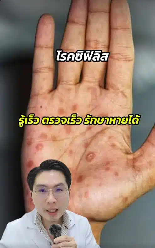หมอตี๋ แชร์ความรู้ โรคซิฟิลิส