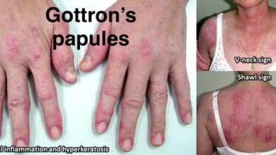 รายแรกในไทย หมอมนูญ เผยเคส ฉีดวัคซีนโควิด mRNA ป่วยโรคภูมิต้านตนเองรุนแรง