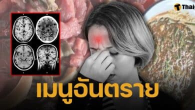 เพจดัง เปิดภาพสยอง พยาธิไชสมองเละ คนไข้ชอบกินซอยจุ๊ อันตรายถึงชีวิต