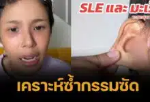 สุดเศร้า แม่เลี้ยงเดี่ยวตรวจเจอ SLE ขณะเป็นมะเร็งระยะสุดท้าย มืดแปดด้าน