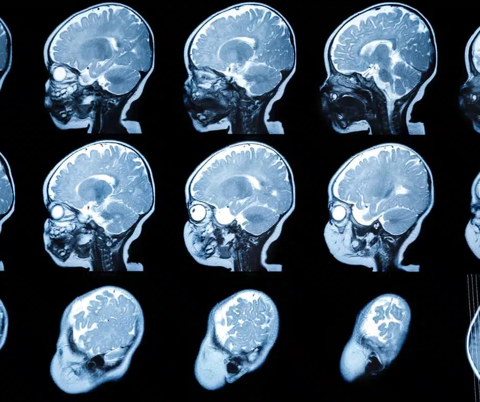 ภาพจัวอย่างฟิล์มเอ็กเรยื ผู้ป่วยโรค เอ็มเอลดี