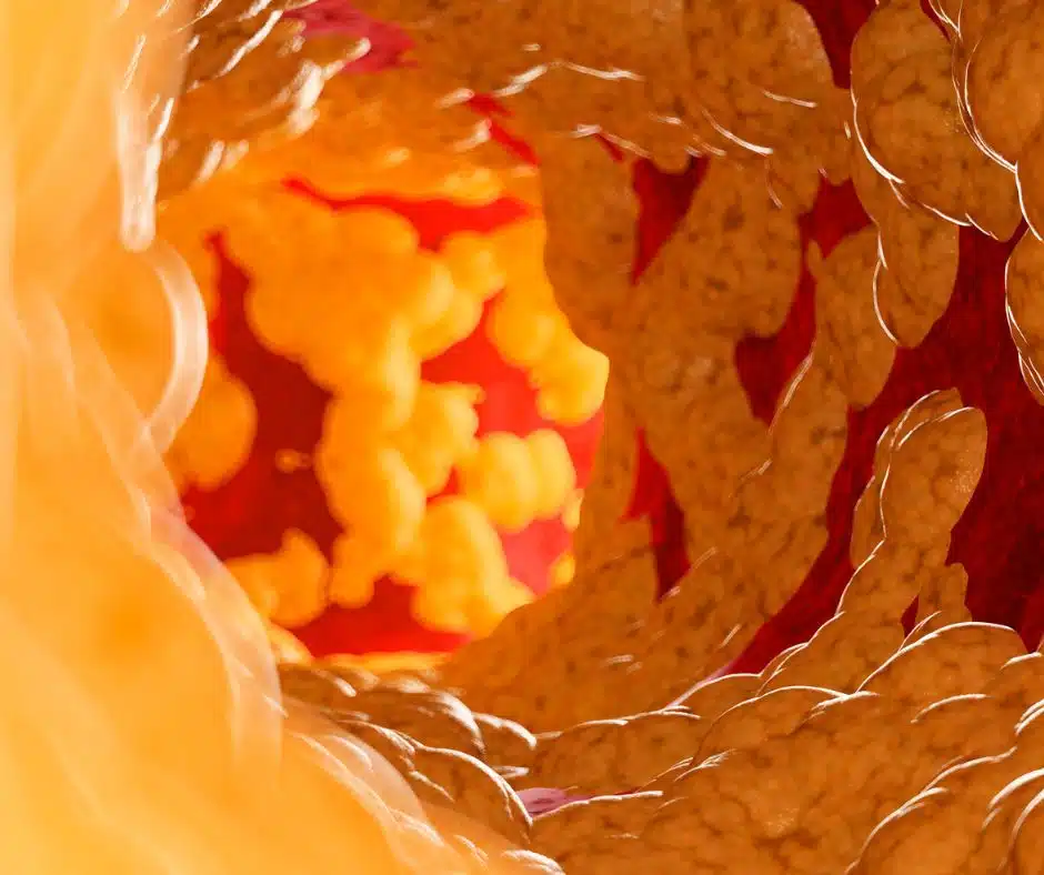 ภาพจำลอง แสดงไขมันในเลือด