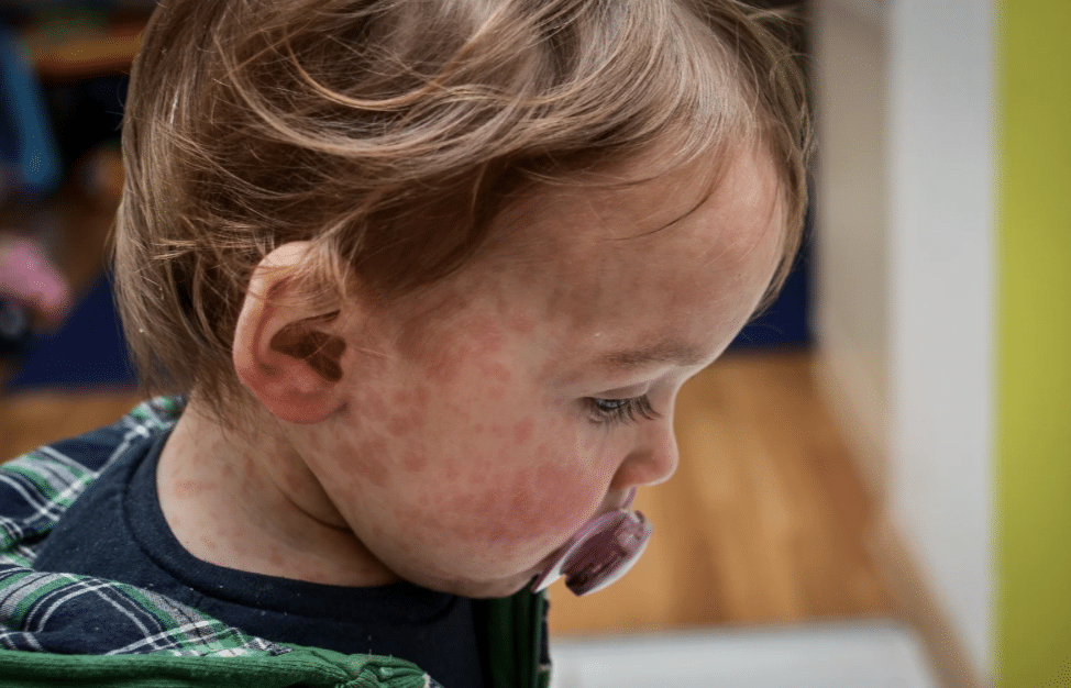 โรคหัดอันตรายถึงชีวิต