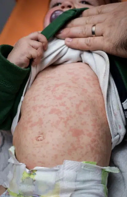 โรคหัดระบาดในเด็ก