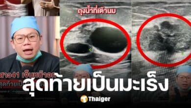 อุทาหรณ์ ครูสาว คลำเจอก้อน-เจ็บหน้าอก คาดเป็นถุงน้ำ ก่อนช็อก ป่วยมะเร็งเต้าน