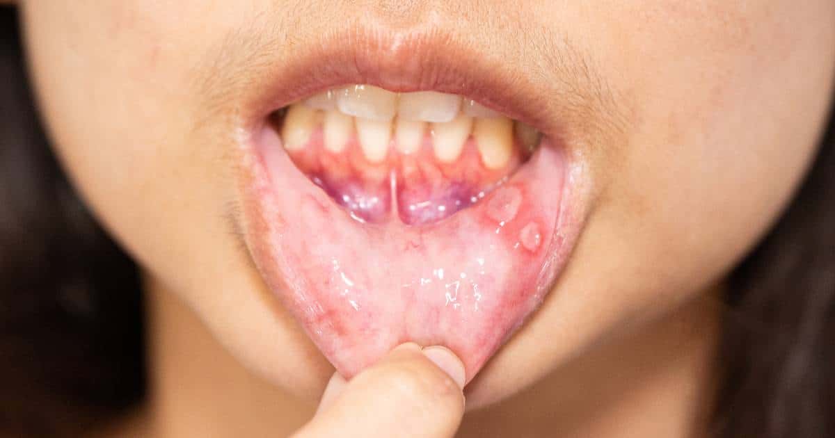 กินลำไยเสี่ยงเป็นร้อนในไหม?