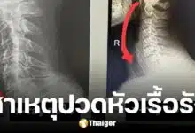 อุทาหรณ์คนติดจอ หมอสมอง ยกเคสปวดหัวเรื้อรัง สาเหตุไม่ใช่สมอง แต่เป็น "คอ"