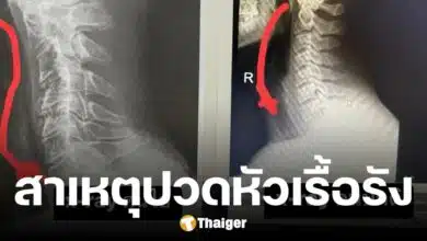 อุทาหรณ์คนติดจอ หมอสมอง ยกเคสปวดหัวเรื้อรัง สาเหตุไม่ใช่สมอง แต่เป็น "คอ"