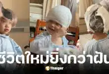 ฉีเป่า เด็กชายวัย 3 ขวบมีไฝยักษ์ผ่านมรสุมถูกล้อเหมือนมิกกี้ เมาส์