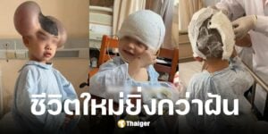 ฉีเป่า เด็กชายวัย 3 ขวบมีไฝยักษ์ผ่านมรสุมถูกล้อเหมือนมิกกี้ เมาส์