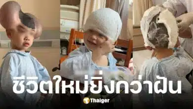 ฉีเป่า เด็กชายวัย 3 ขวบมีไฝยักษ์ผ่านมรสุมถูกล้อเหมือนมิกกี้ เมาส์