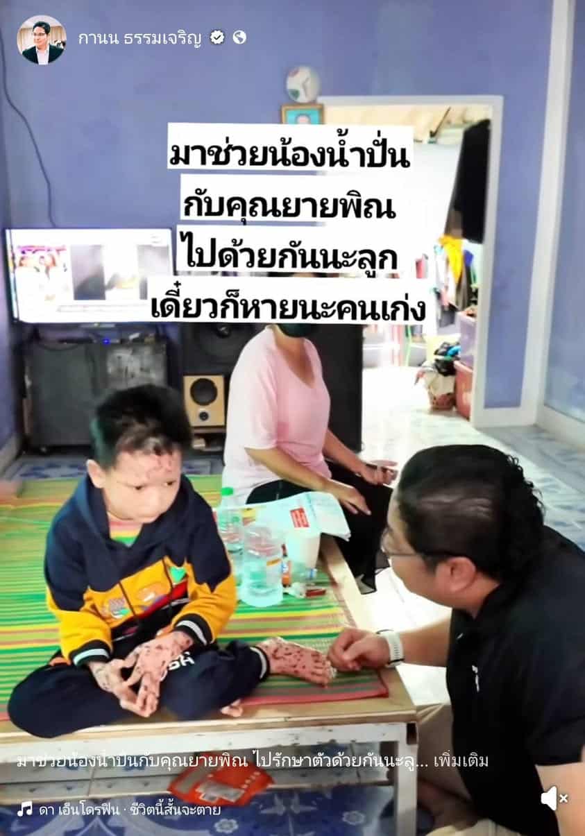 'น้องน้ำปั่น' ทรมาน ป่วยโรคตุ่มน้ำพอง 6 ปี อาศัยอยู่กับยาย ได้ทนายไพศาลช่วยทำข่าว ตอนนี้ได้ไปรักษากับหมอเฉลิมพลแล้ว รักษาด้วยยาสมุนไพร