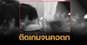 อุทาหรณ์ หนุ่มก้มหน้าติดจอหนัก จนกระดูกคอห้อย เงยหน้าไม่ขึ้น กลืนอาหารลำบาก
