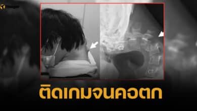 อุทาหรณ์ หนุ่มก้มหน้าติดจอหนัก จนกระดูกคอห้อย เงยหน้าไม่ขึ้น กลืนอาหารลำบาก