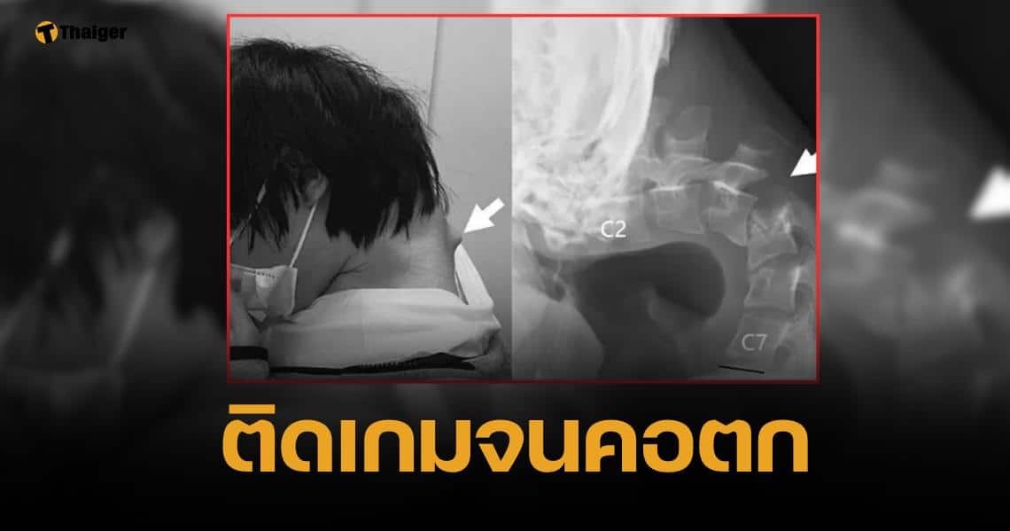 อุทาหรณ์ หนุ่มก้มหน้าติดจอหนัก จนกระดูกคอห้อย เงยหน้าไม่ขึ้น กลืนอาหารลำบาก
