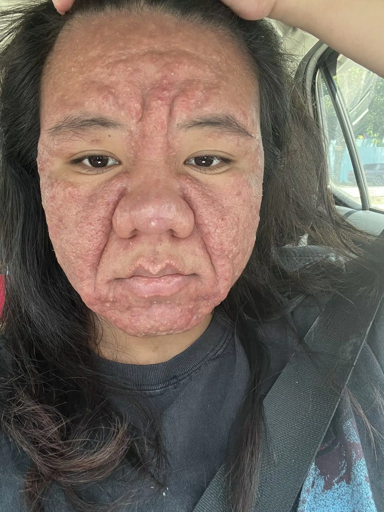 คุณแม่รายหนึ่งไม่แพ้ท้องแต่ใบหน้ามีสิวขึ้นรุนแรง
