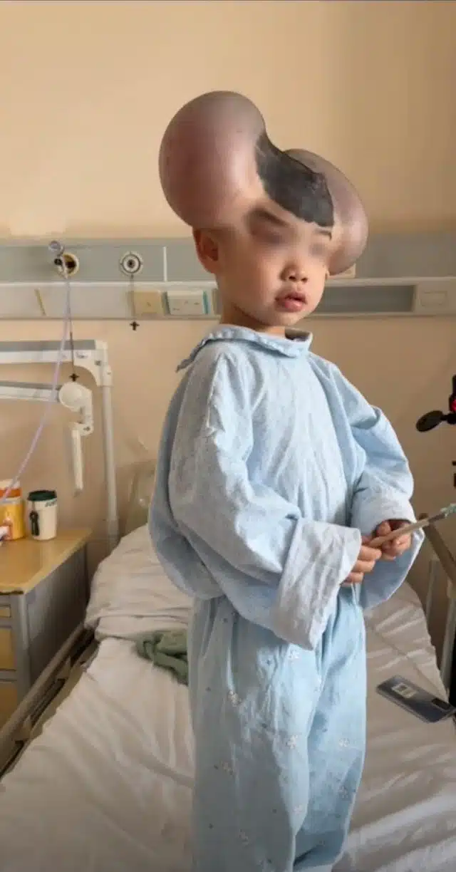 ฉีเป่า หนูน้อย 3 ขวบมีไฝยักษ์ตั้งแต่เกิด