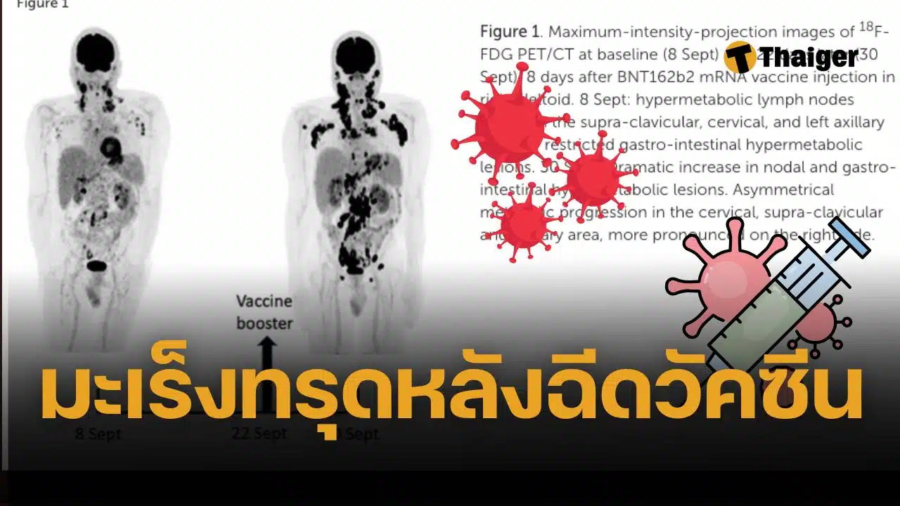 วิจัยพบ ผู้ป่วยมะเร็งต่อมน้ำเหลืองอาการทรุดเร็ว หลังฉีดวัคซีน mRNA เข็มกระตุ้น
