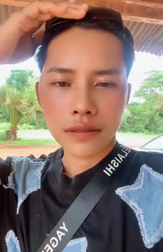 ใบหน้าไล ไทย หลังศัลยกรรมดวงตา