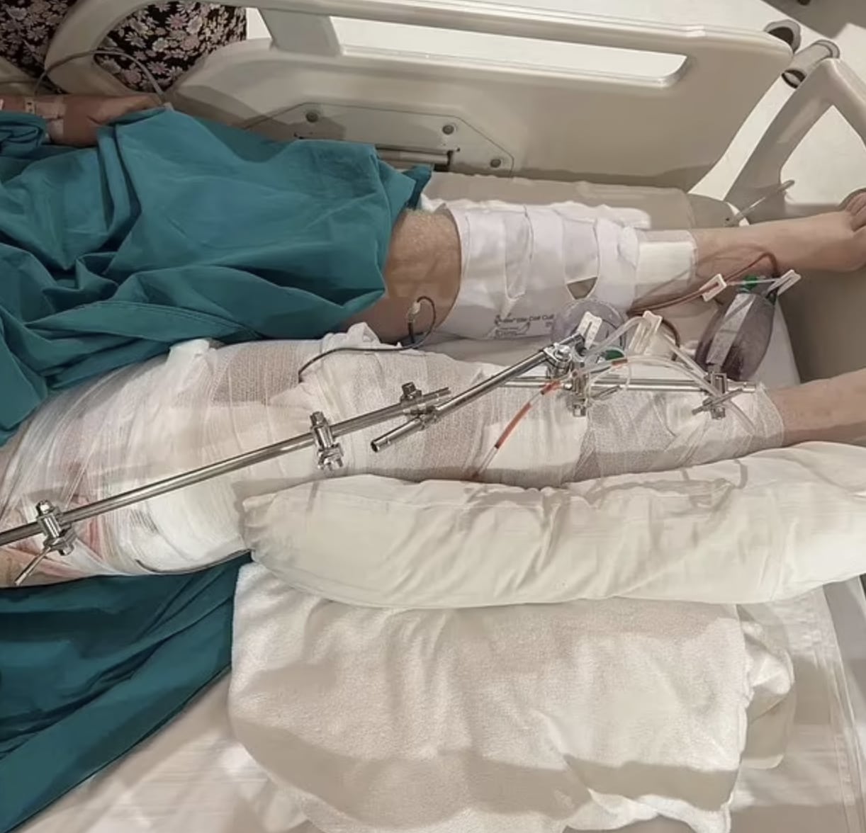 สื่อนอกตีข่าว นทท.อังกฤษ พลัดตกน้ำตกเกาะสมุย กะโหลกแหลกสาหัส ค่ารักษาพุ่ง 4.5 ล้าน วอนพากลับบ้าน