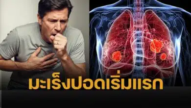 lung cancer early stage