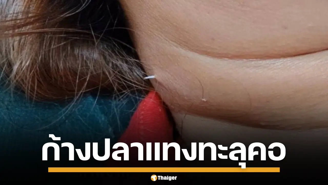 อุทาหรณ์ ก้างปลาติดคอถึง 2 อาทิตย์ จนแทงทะลุคอ หมออึ้งเพิ่งเคยเห็น