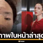 คลาวเดีย เปิดภาพใบหน้า หลังล้มฟาดฟื้น ต้องคอยซับเลือดไหล