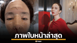 คลาวเดีย เปิดภาพใบหน้า หลังล้มฟาดฟื้น ต้องคอยซับเลือดไหล