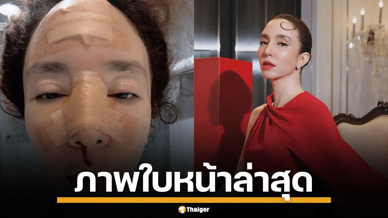 คลาวเดีย เปิดภาพใบหน้า หลังล้มฟาดฟื้น ต้องคอยซับเลือดไหล