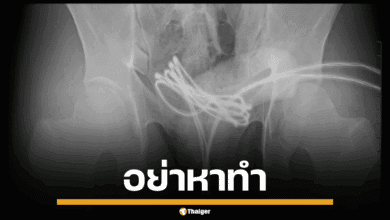 อย่าหาทำ ใส่สาย USB เข้าน้องชายตัวเอง หมอหมูชี้เสี่ยงติดเชื้อ
