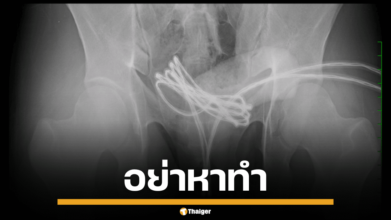อย่าหาทำ ใส่สาย USB เข้าน้องชายตัวเอง หมอหมูชี้เสี่ยงติดเชื้อ